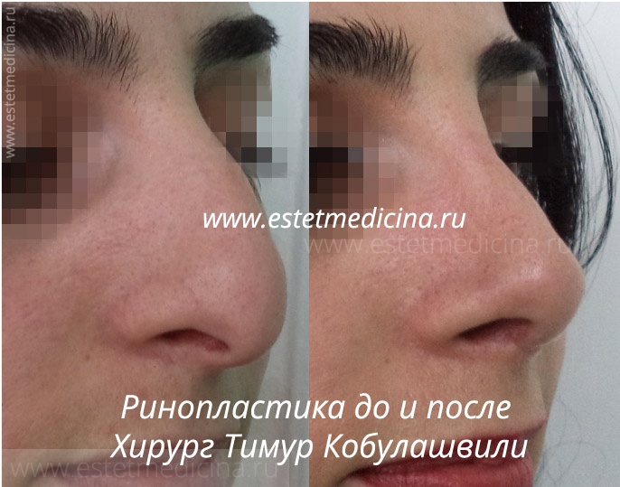 Ринопластика кавказского носа Кобулашвили 