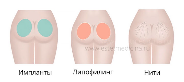 Варианты увеличения, подтяжки ягодиц Варианты увеличения, подтяжки ягодиц