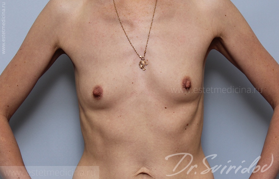 увеличение груди, фото до, хирург Сергей Свиридов