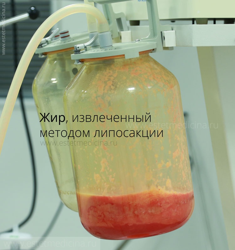 Жир, извлеченный методом липосакции Жир, извлеченный методом липосакции