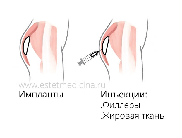 Инъекции в ягодицы: жир или филлер Инъекции в ягодицы: жир или филлер