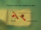 Удаленные участки кожи и подкожно-жировой клетчатки