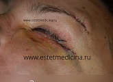 3 сутки после пластики нижних век
