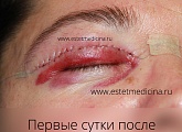 Первые сутки после пластики верхних век
