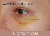 8 сутки после трансконьюктивальной пластики нижних век
