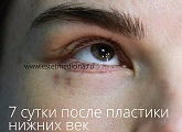 7 сутки после пластики нижних век