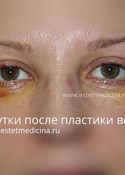 Восстановление после блефаропластики Восстановление после блефаропластики