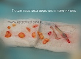 Объемы удаленной кожи и подкожно-жировой клетчатки