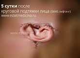 5 сутки после круговой подтяжки лица (СМАС-пластики)