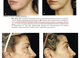 До и после липофилинга лица (фото)