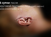 5 сутки после круговой подтяжки лица (СМАС-пластики)