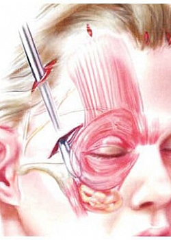 Эндоскопическая подтяжка лица и классический фейслифтинг Эндоскопическая подтяжка лица и классический фейслифтинг