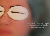 Повязка после операции на веках