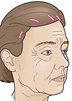 Эндоскопический лифтинг лба, темпоропластика Эндоскопический лифтинг лба, темпоропластика